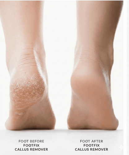 Electric Foot File – Instant Callus Remover for Soft & Smooth Feet